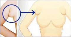 副乳病症有哪几种类型